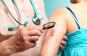 Vitamina C pode ajudar pessoas com alterações pré-cancerígenas no sangue