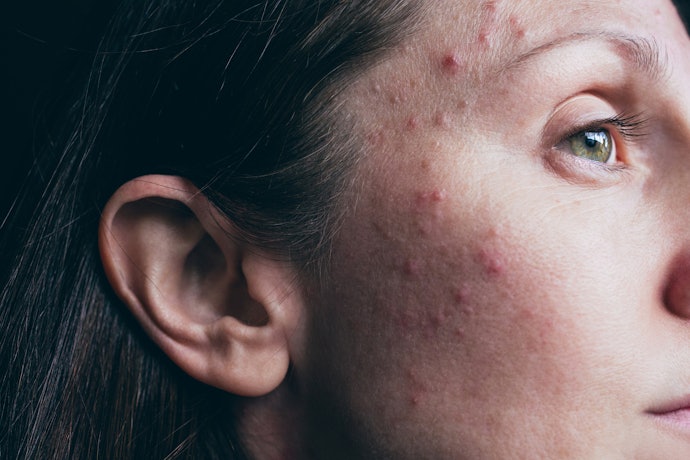 Acne Tem Cura? Como Tratar?