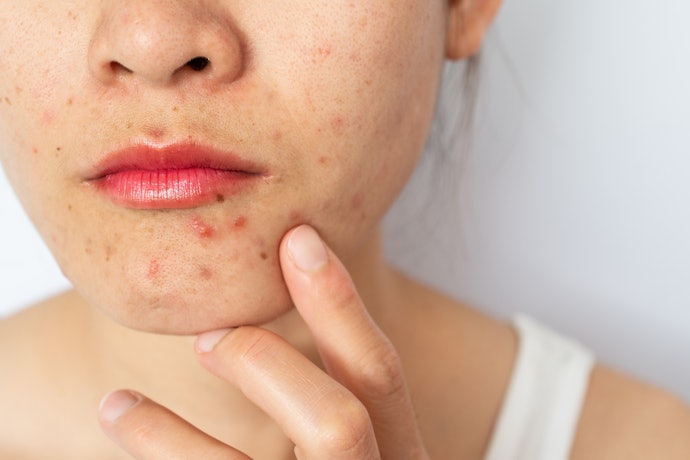 Quais São os Tipos de Acne?